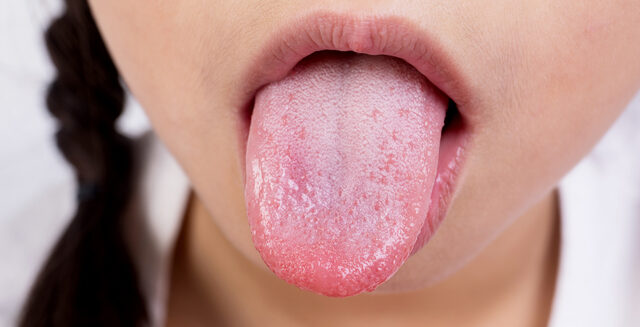 舌が白くなる原因とは？口内環境の悪化サインを見逃さない