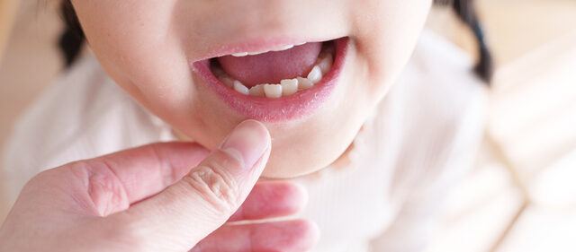 顎が小さい子が将来起こしやすい口元トラブル