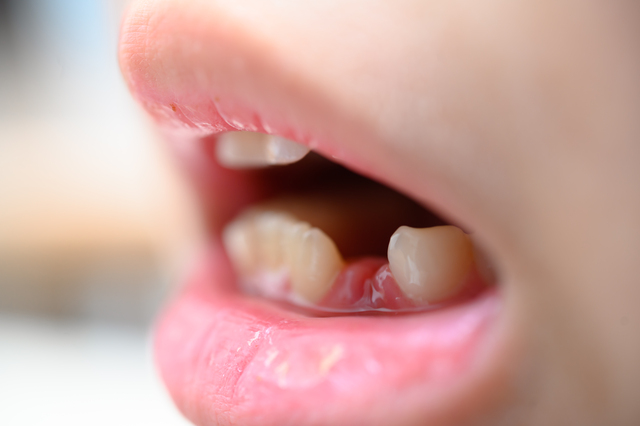 歯並びが悪い子に共通する生活習慣とは