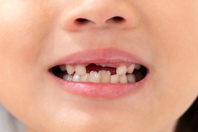 子どもの前歯がガタガタに生える原因と対処法