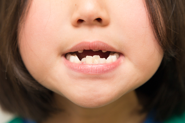 子どもの歯並びが気になるときに見るべきポイントと相談の目安