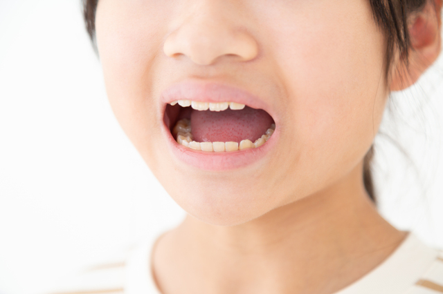 口呼吸の子は要注意？歯並びと健康への影響
